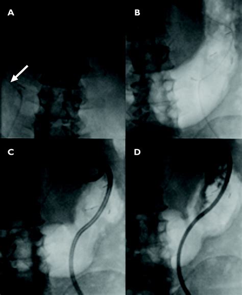 Radiologic Percutaneous Gastrostomy: Review of Potential。